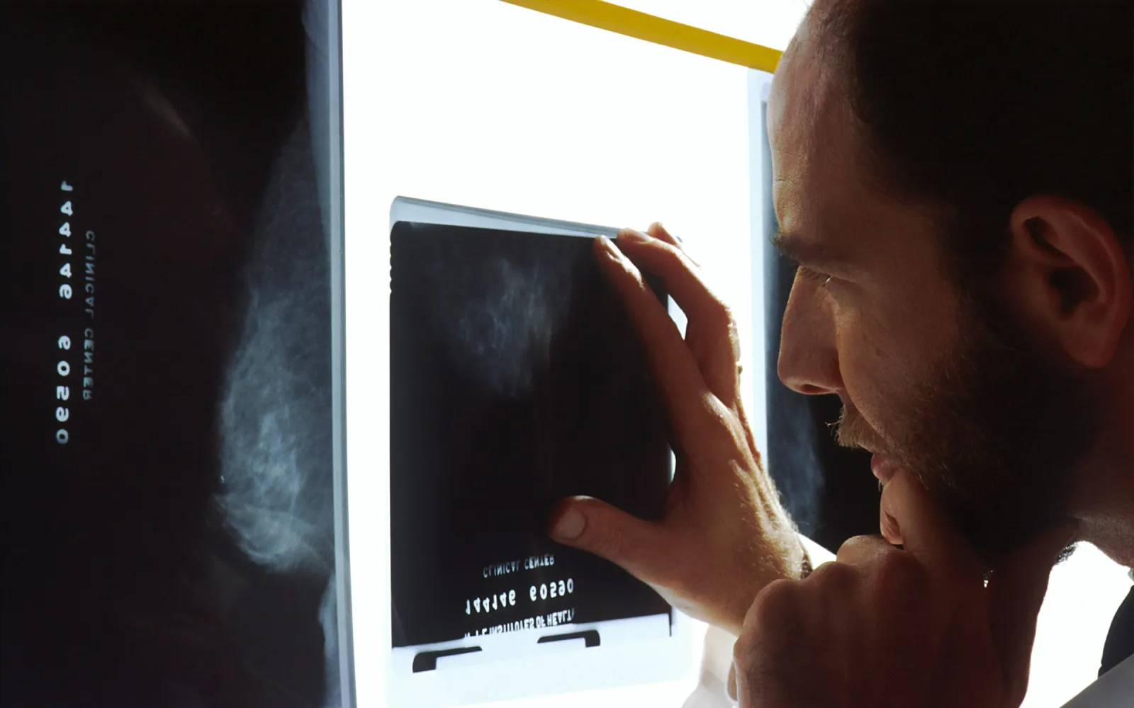 3D Mammography: How Tomosynthesis Works